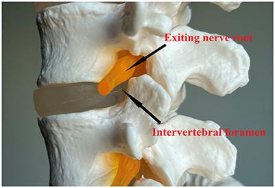 Frontiers | Transforaminal Endoscopic Discectomy Under General And ...